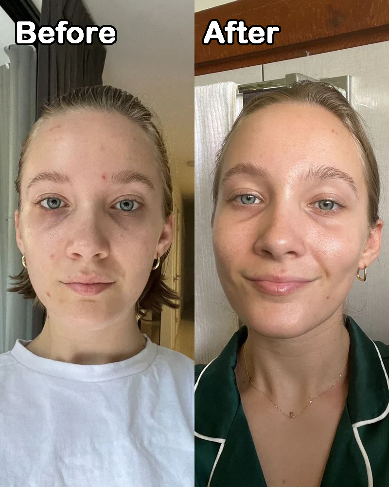 Before and after comparison of a person with visible skin concerns.