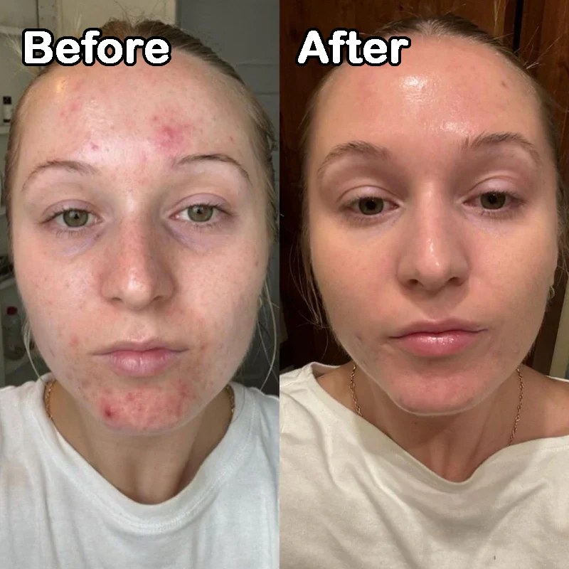 Before and after comparison of a person's face with visible skin improvement.