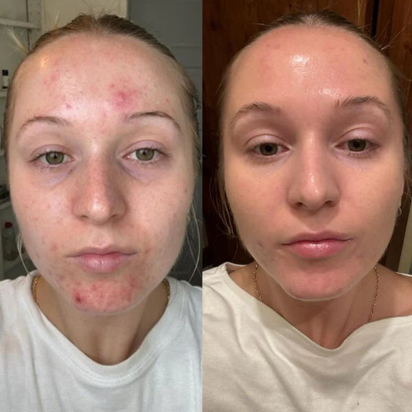 Before and after comparison of a person's face with visible skin conditions.