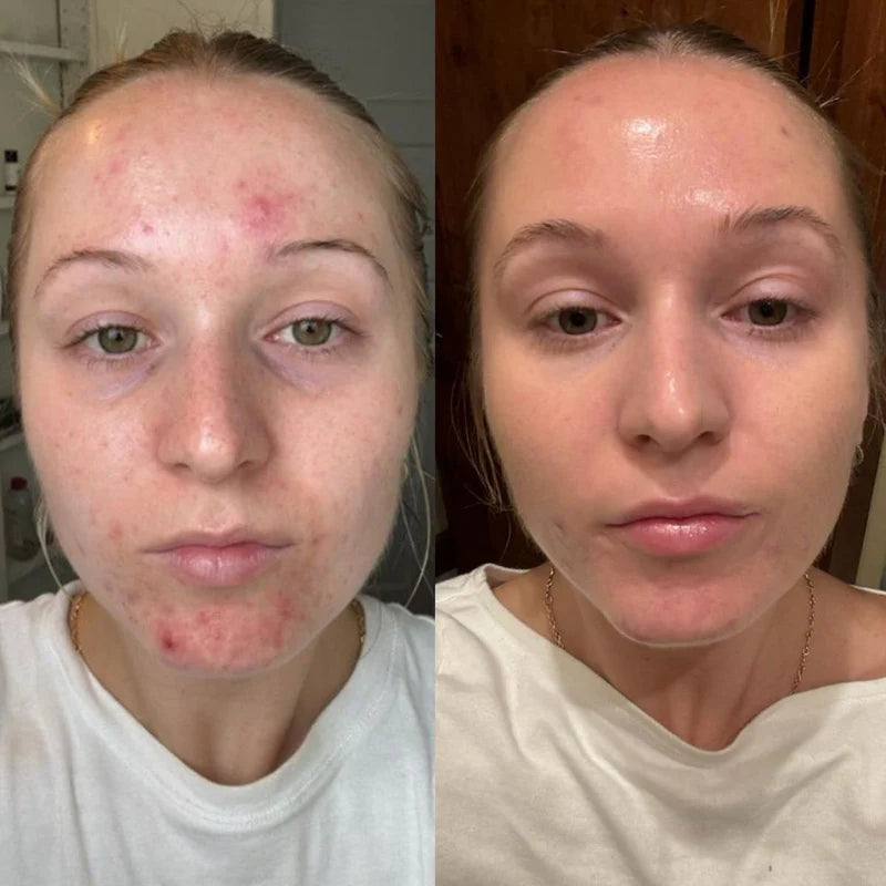 Before and after comparison of a person's face with visible skin conditions.