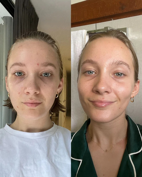 Before and after comparison of a person with acne on their face.